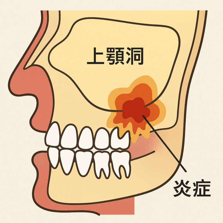歯が原因で生じる蓄膿症 “歯性上顎洞炎” とは?? | 川崎駅前「佐藤歯科」