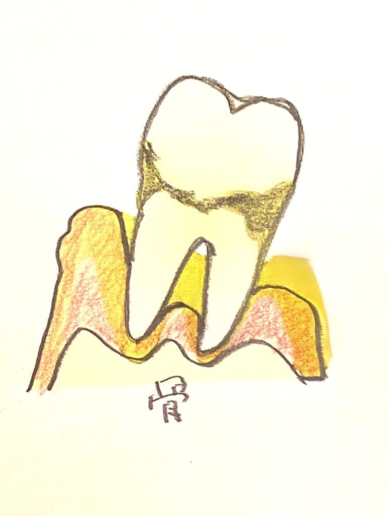 歯周病が悪化して動揺が激しくなった状態をイラストで説明しています。