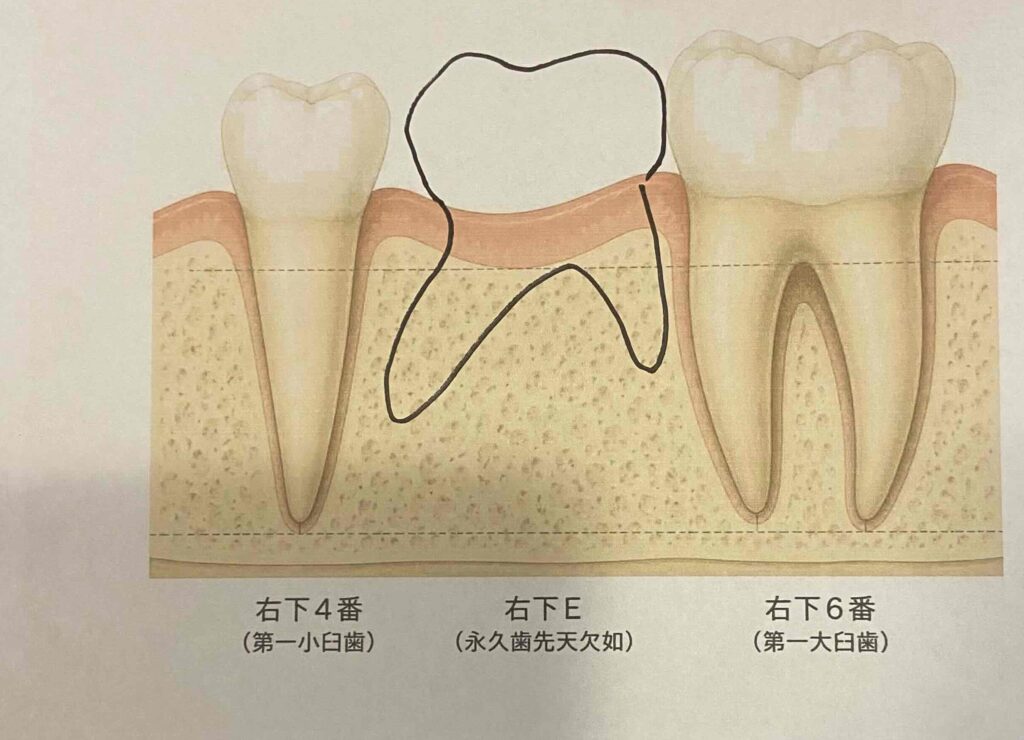 永久歯の歯列の中で乳歯が残っていた場合の歯根の短さを模式的に表しています。