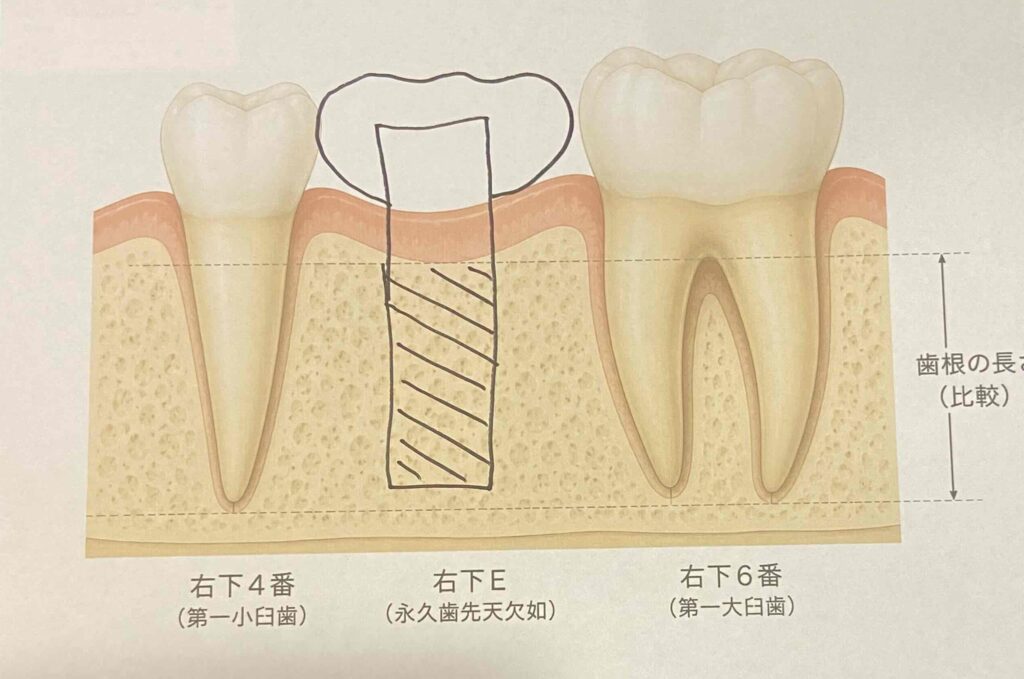 欠損に対して補綴で対応するときの、インプラントのありようを模式的に表しています。