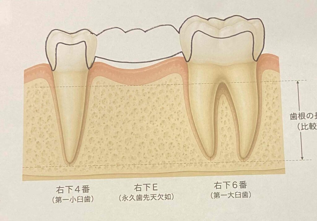 欠損に対してブリッジで補綴した場合の様子を模式的に表しています。