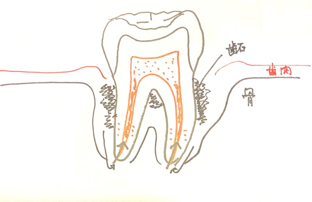 歯周病のせいで上行性歯髄炎が起きる様子を模式的に説明しています。