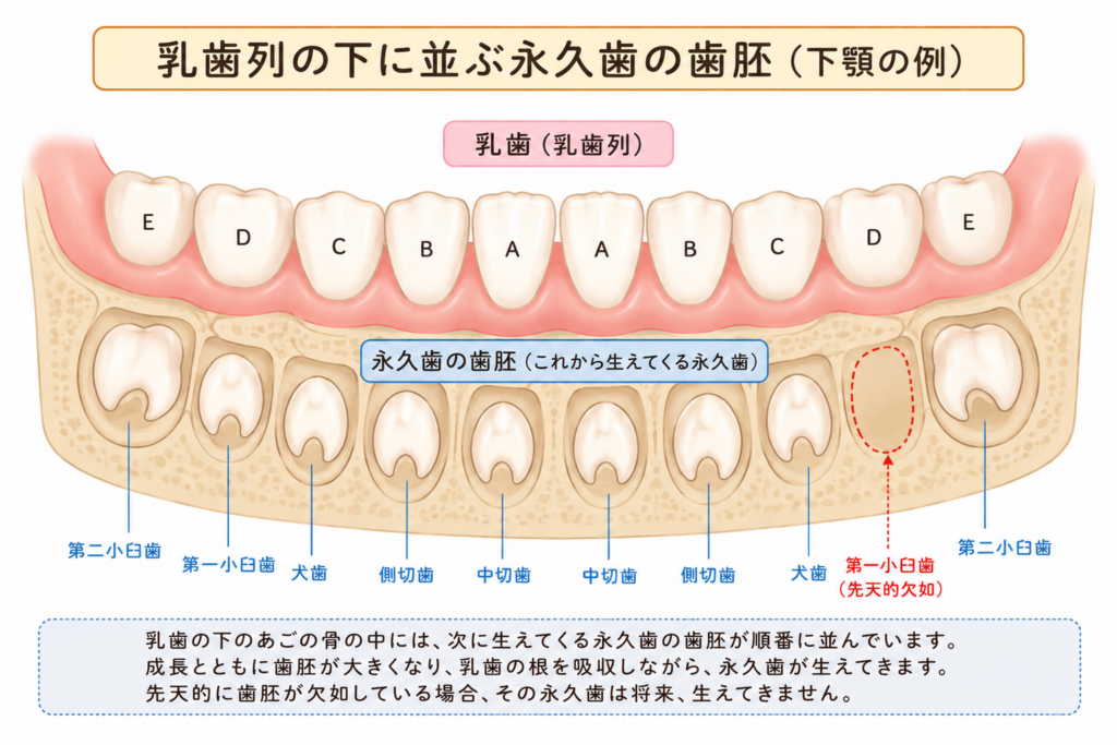 乳歯の歯列の中で永久歯の歯胚が一つだけ欠損している様子を模式的に表しています。