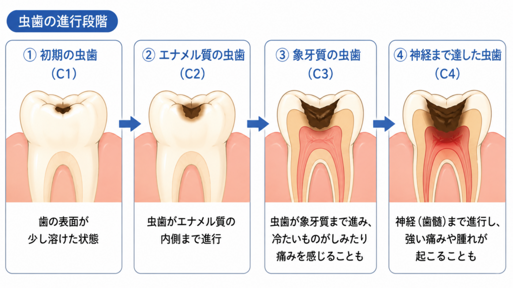 虫歯が進んで歯髄炎を起こして行く過程を模式的に表しています。