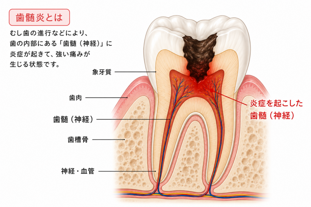 普通の歯髄炎が起きる様子をイラストで解説しています。