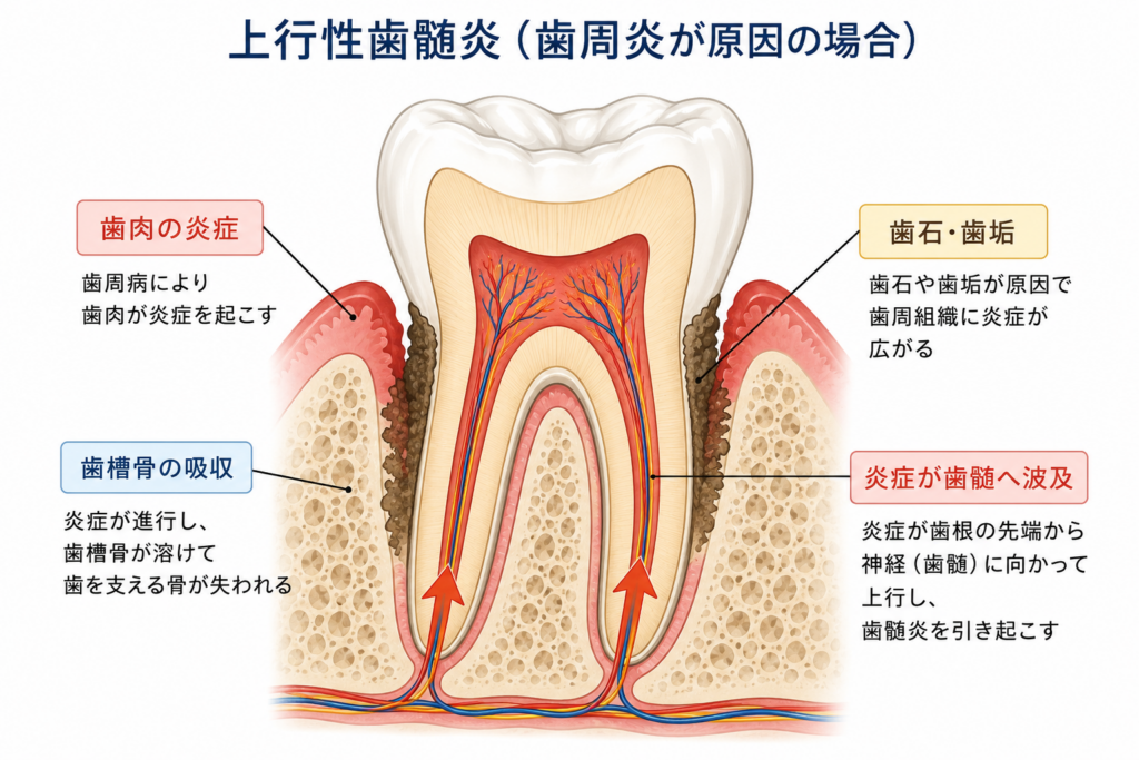 歯周病が悪化してじょうこぷ性歯髄炎が起きる様子をイラストで説明します。