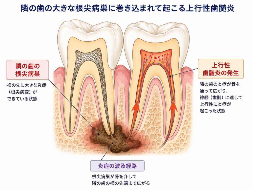 隣の歯の根尖病巣に巻き込まれて上行性歯髄炎が起きる様子を模式的に設営しています。