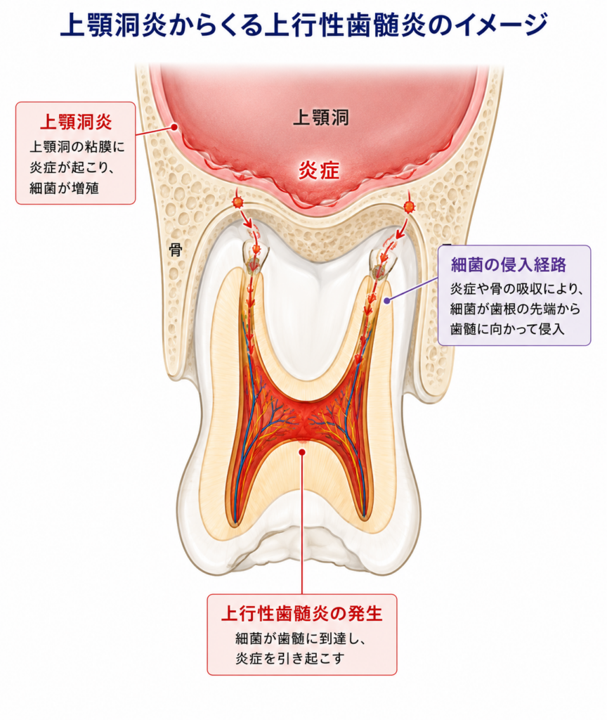 上顎洞炎のせいで上行性歯髄炎が起きる様子を模式的に説明するイラストです。