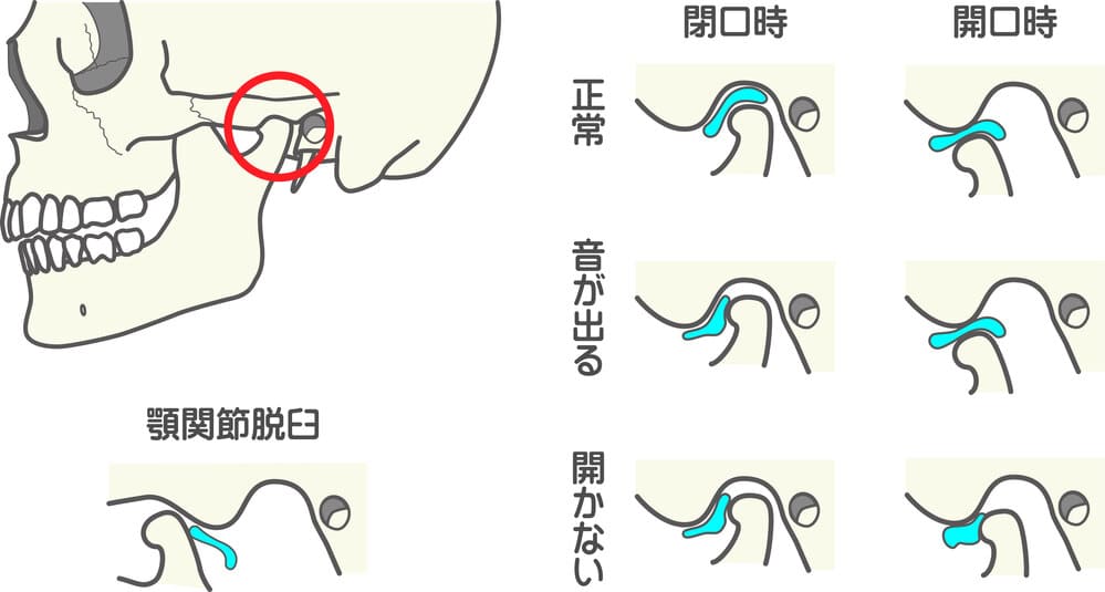 顎関節症と関節円盤の状態を示す図。