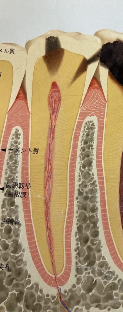 虫歯が歯髄に近づいてきて、治療すると抜髄になりそうな状態を図示しています。この場合でも処置前名痛くないことが多いです。