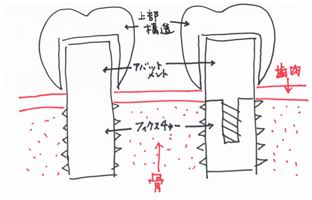ワンピースインプラントとツーピースインプラントの構造の違いを模式的に説明するイラスト