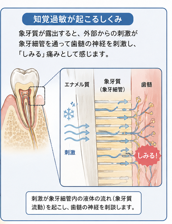 知覚過敏でしみると感じる仕組みを解説しています。キーワードはエナメル質、象牙質、象牙細管、歯髄。