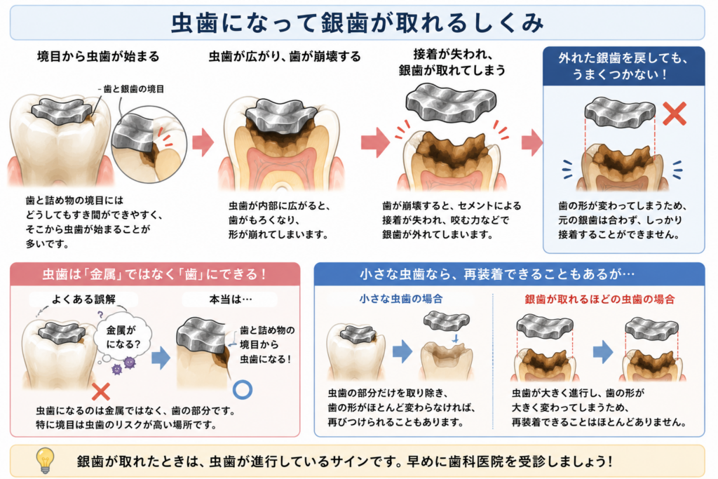 虫歯のせいでインレーが取れてしまうことを解説しています。