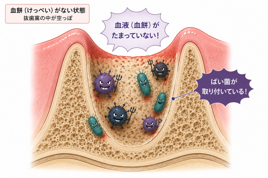 抜歯窩にばい菌が取り付いている様子