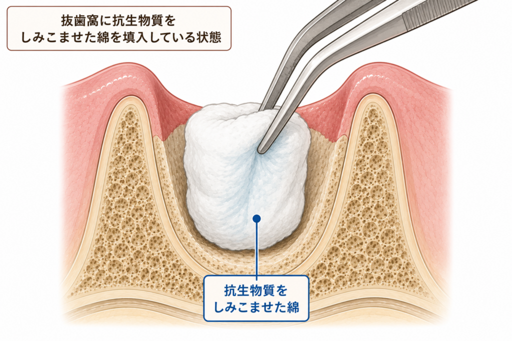 ドライソケットのたいっ処方の一例を図示