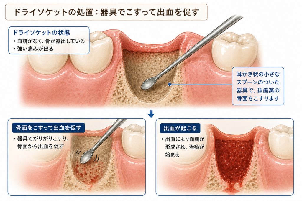 ドライソケットの対処法の一例を図示。抜歯窩再掻把。