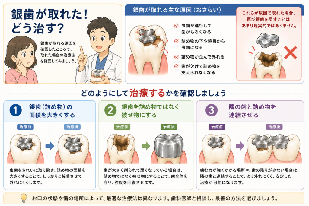 インレーが取れた場合の治し方を3パターン提示しています。