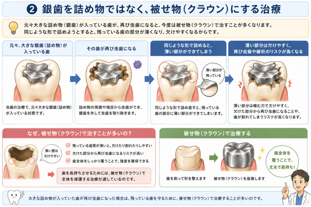 インレーが外れた時にクラウンにやり替えるパターンを解説しています。