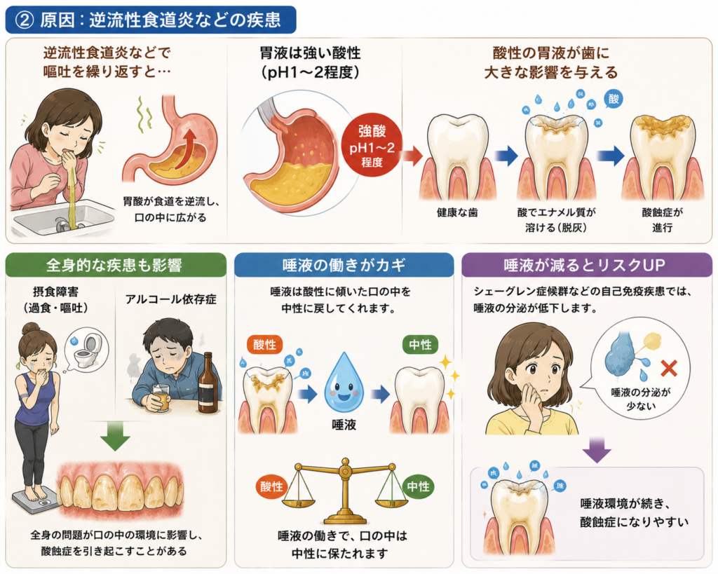 逆流性食道炎や全身的疾患が酸蝕症に影響することを解説。唾液の働きについても言及。
