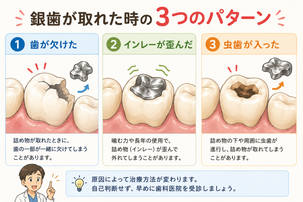 銀歯が取れる3つのパターンの解説図です。