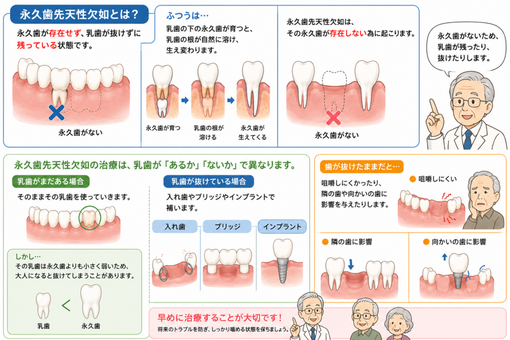 永久歯の先天欠如の仕組みとその治療法について解説しているイラスト。