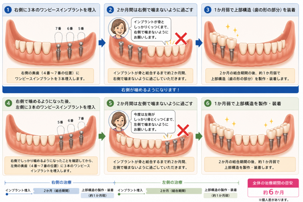 両側遊離端欠損をインプラント補綴する場合の具体的な段取りを解説するイラスト
