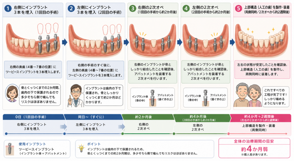 両側遊離端欠損をインプラント補綴する際にツーピースインプラントを使った場合の具体的な段取りをイラストで説明。