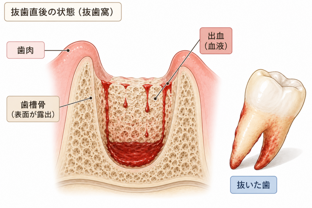抜歯直母の抜歯窩の様子を示したイラスト