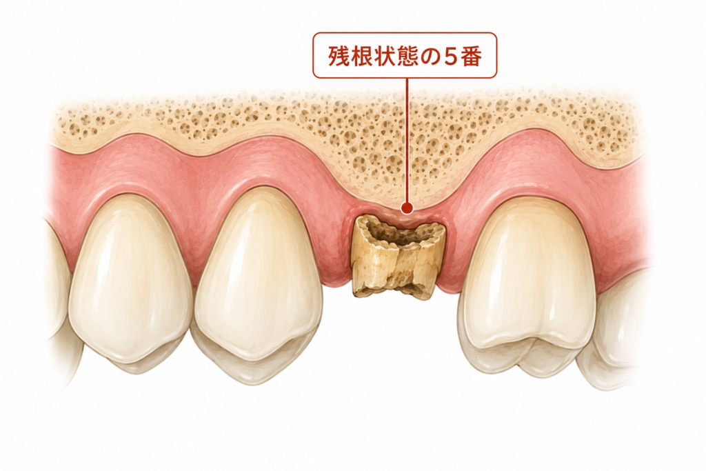 残根状態で小さくなった根っこの抜歯ではもしかしたら投薬しなくても問題なく治るかもしれない、の図