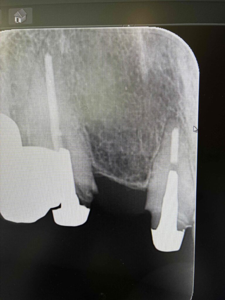 前歯のブリッジが脱離した時の写真です。右上1番はほぼ健全でしたが、右上3番は虫歯が入っていて、金属の土台の下の自部の歯の部分が黒く映っています。