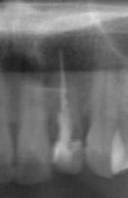 患部の歯の部分を拡大した写真です。根尖病巣が小さく映っていますが、歯冠部の歯質に虫歯のような影も見られます。