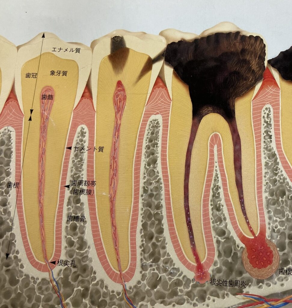 根尖病巣がどのようなものかを解説するイラスト。