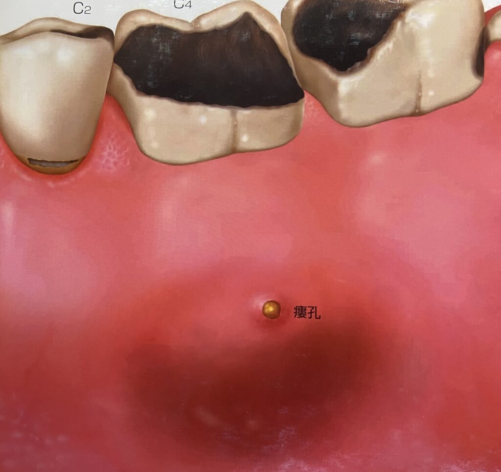 フィステルとは内部にできた炎症からつながる膿の出口であること示すイラスト。