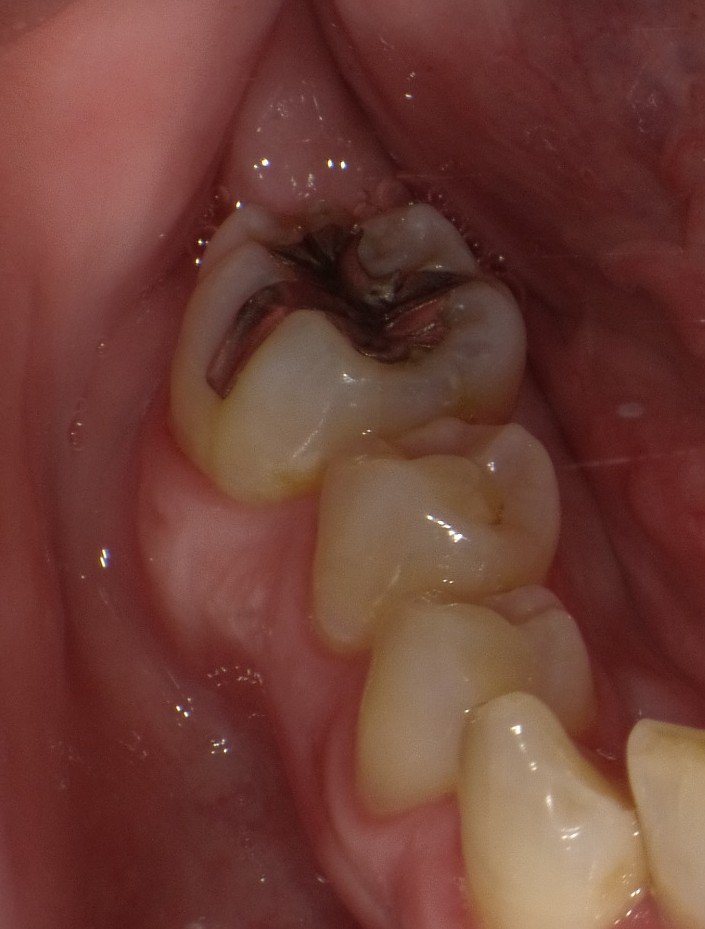 抜歯をして5年たっている現実の口腔内写真