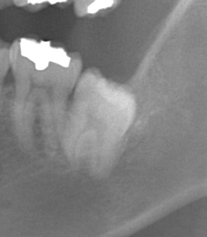 左下の7番が智歯のごとく埋まっている様子を示すレントゲン写真。