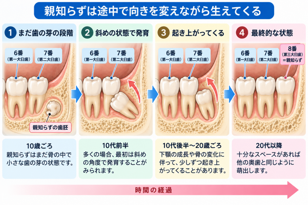 親知らずがどのように萌出して行くのかを解説するイラスト。