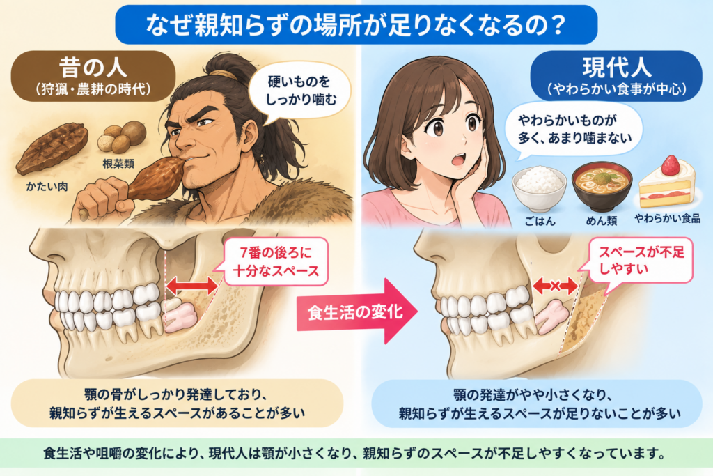 なぜ現代人は親知らずのスペースが足りないかを解説するイラスト。