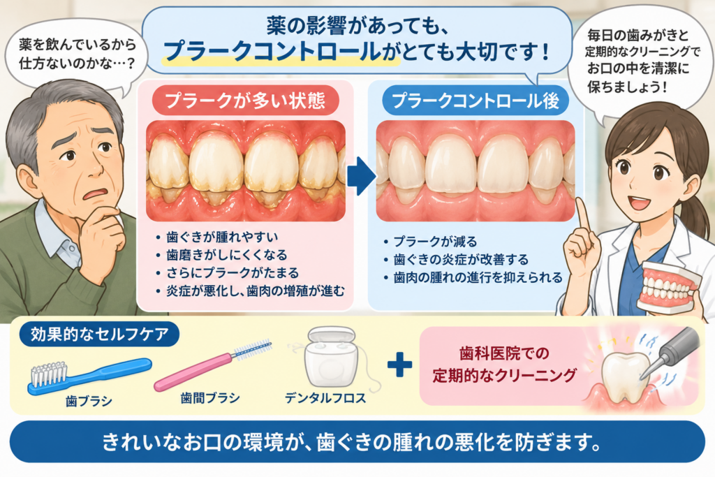 プラークコントロールの重要性を解説するイラスト。