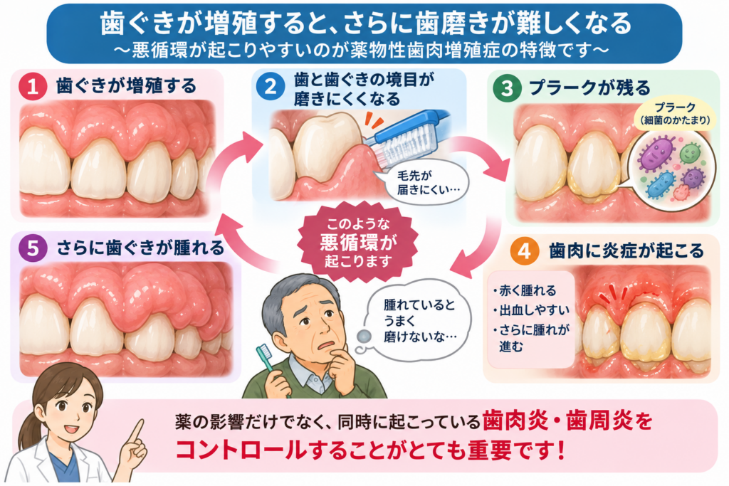 歯肉増殖によってプラークコントロールが難しくなり、炎症が起こりやすいことを解説するイラスト。