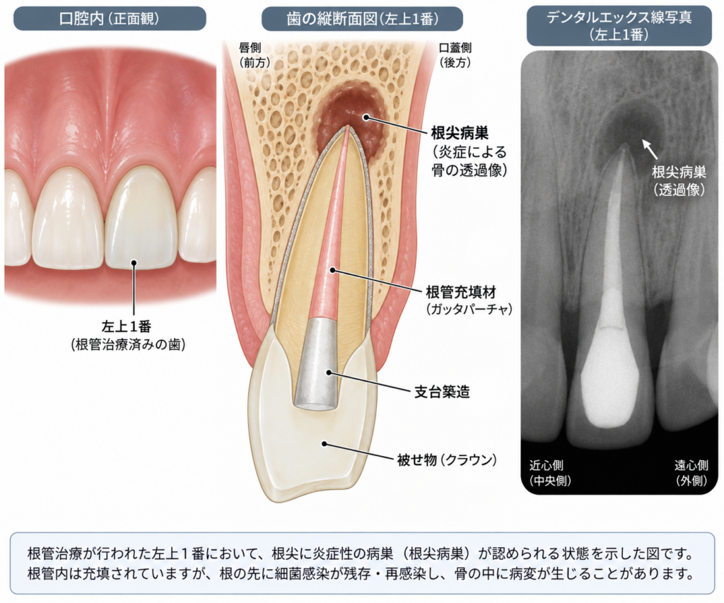 前歯の根尖病巣とはどのようなものかをイラストで解説。