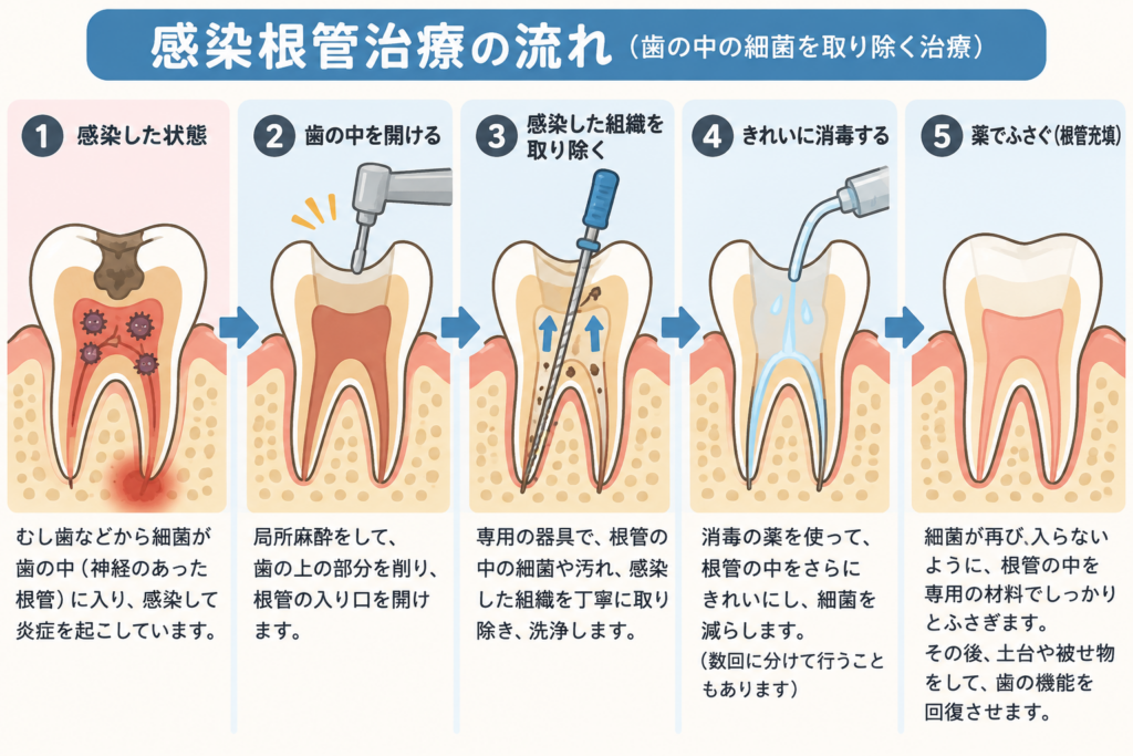 感染根管治療の具体的段取りを示すイラスト。