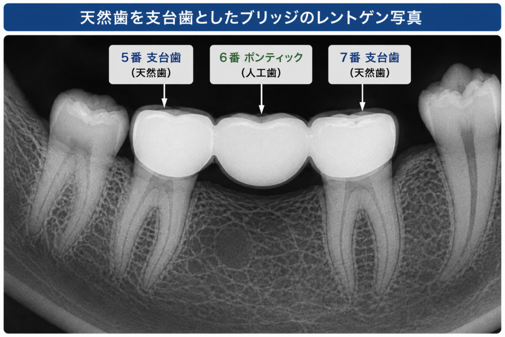 ブリッジという構造物を説明するレントゲン写真。