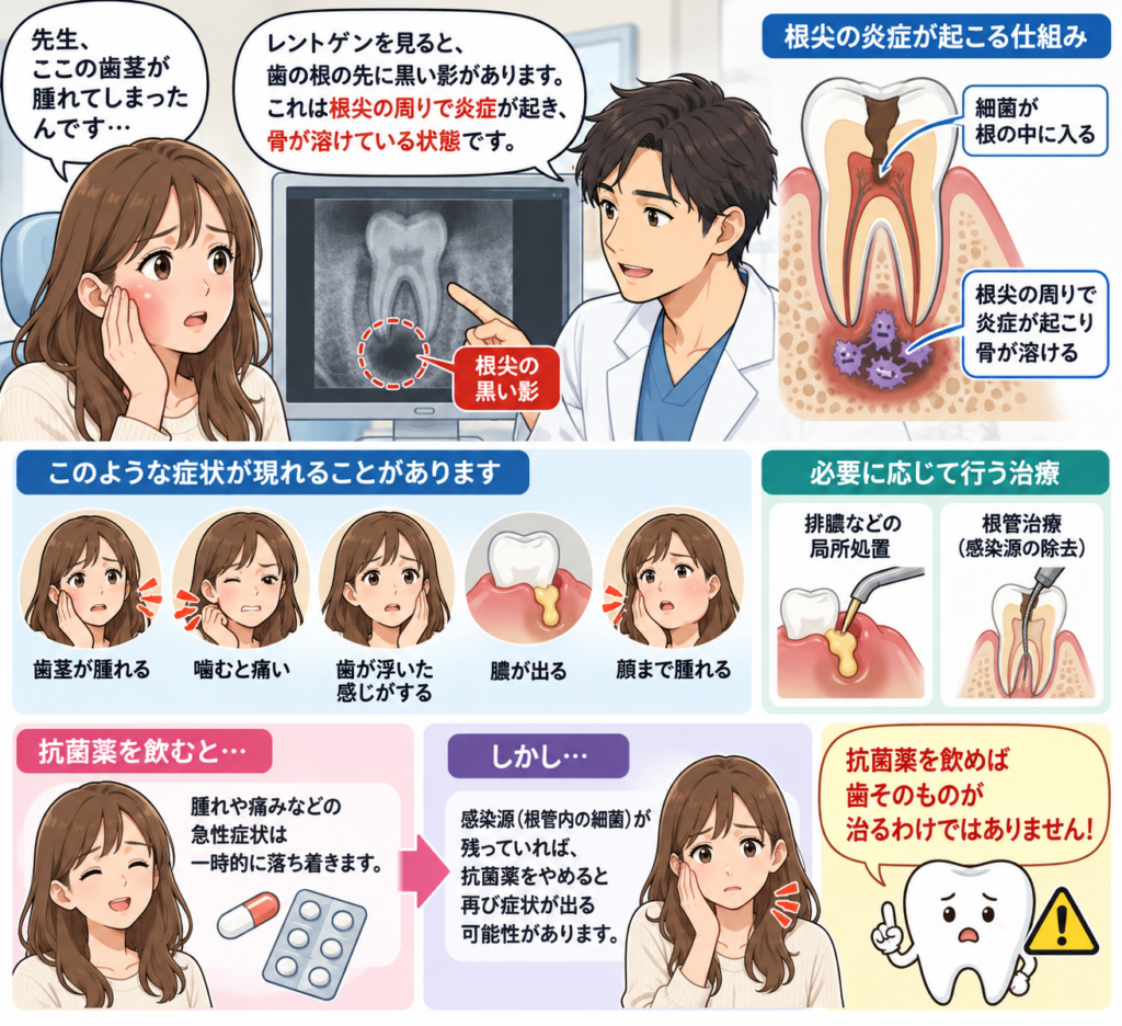 歯肉に炎症が起きるほとんどは混成病巣であることが多い。その病態と対処法として抗菌薬を使うことを示す図