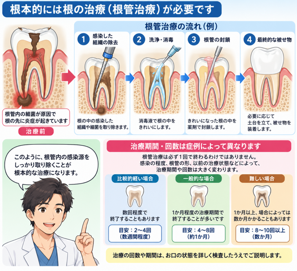 根本的治すには根管治療が必要であることを解説する図。