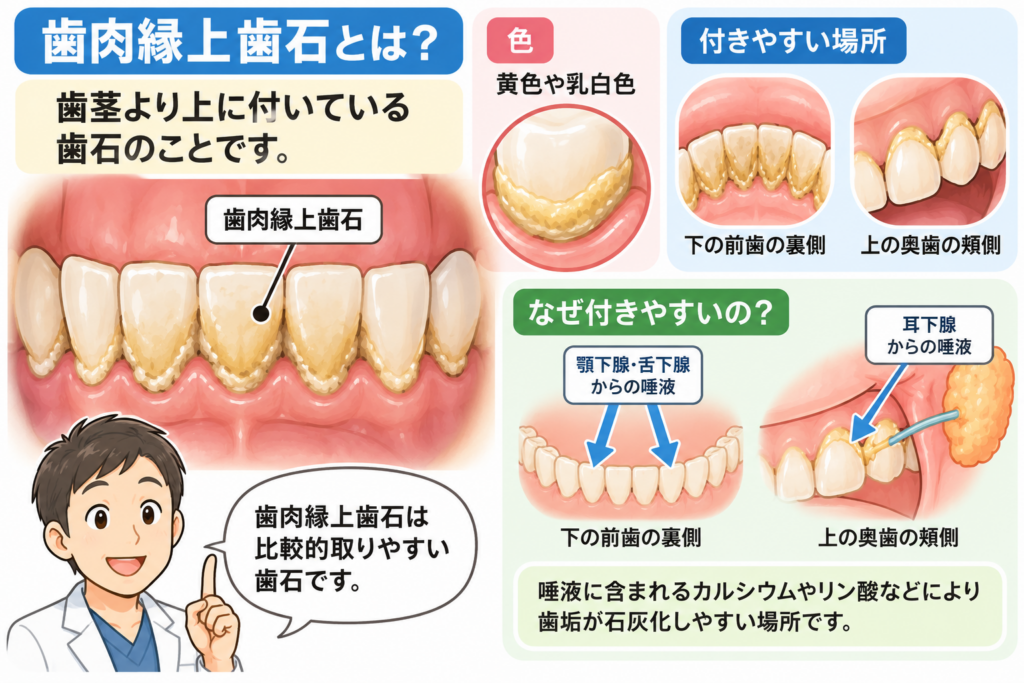 歯肉縁上歯石についての解説図。顎下腺、舌下腺。耳下腺。