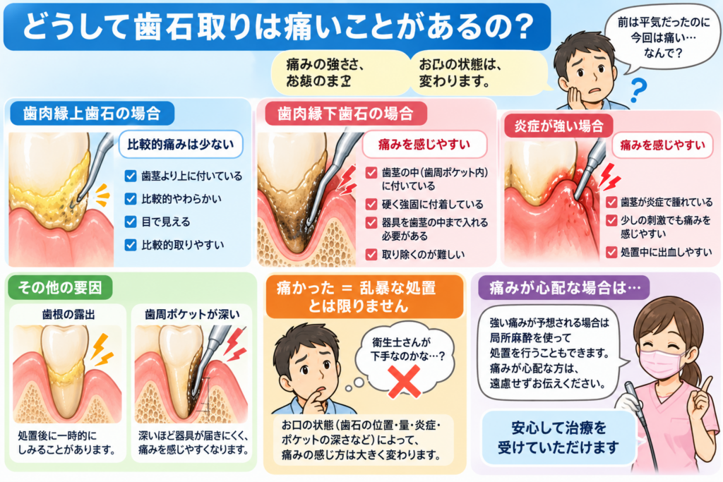 歯石取りが痛い理由についての解説図。衛生士。歯根。歯周ポケット。炎症。