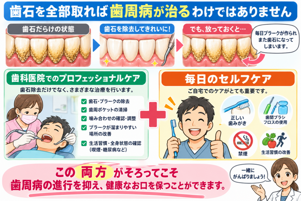 歯石取りで歯周病が治るわけではないことの解説。セルフケア、プロフェッショナルケア。