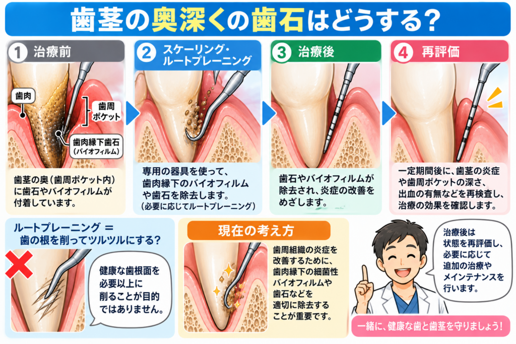 歯茎の奥の歯石取りの解説。スケーリング。ルートプレーニング。バイオフィルム。根面。