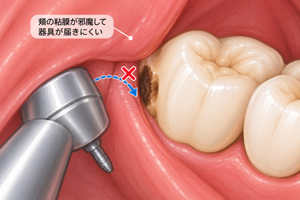 上顎最後臼歯の虫歯治療が困難な状態をイラストで説明しています。