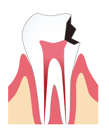 大きな虫歯とは？